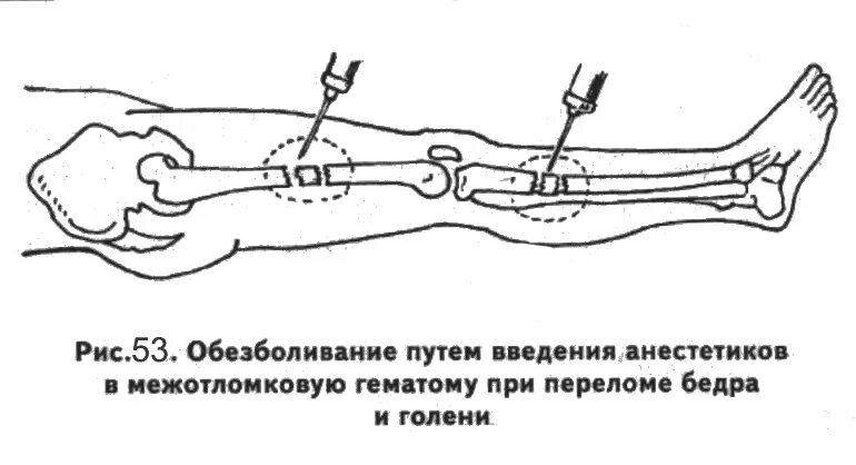 Обезболивающие при открытом переломе. Новокаиновая анестезия. Новокаиновая блокада при переломах костей. Новокаиновая блокада при переломе диафиза бедра. Провести инфильтрационную анестезию при переломе голени..