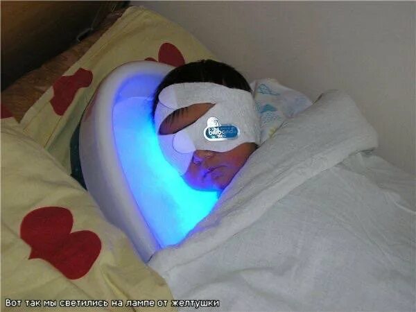 Очки для фототерапии новорожденных philips weespecs. Очки для лампы от желтушки. Очки для фототерапии billiband. Фототерапия при желтухе. Очки для лампы от желтушки.