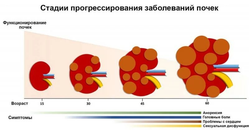 Онкология почек стадии. Карцинома почки 2 стадия. Нефроптоз почек степени. Почки 3 стадия. Почки 3 стадия.