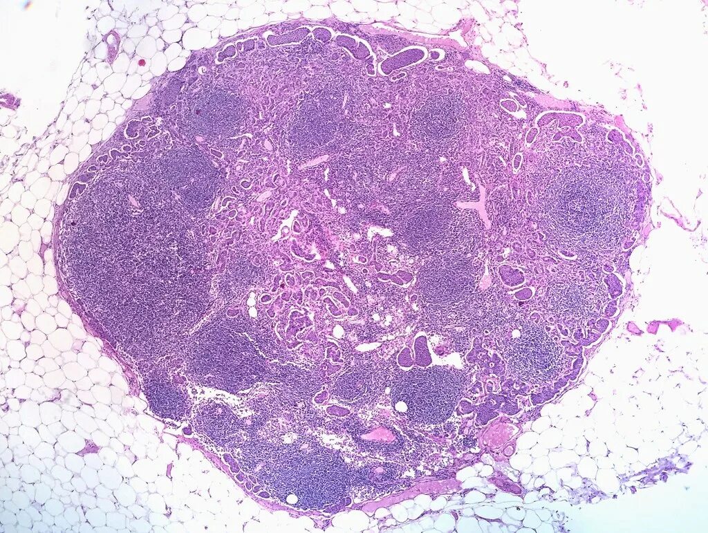 Лимфогранулематоз гистология. Папиллярная гидраденома гистология. Метастазы аденокарциномы гистология. Ксантомные клетки гистология. Жидкость в лимфоузле