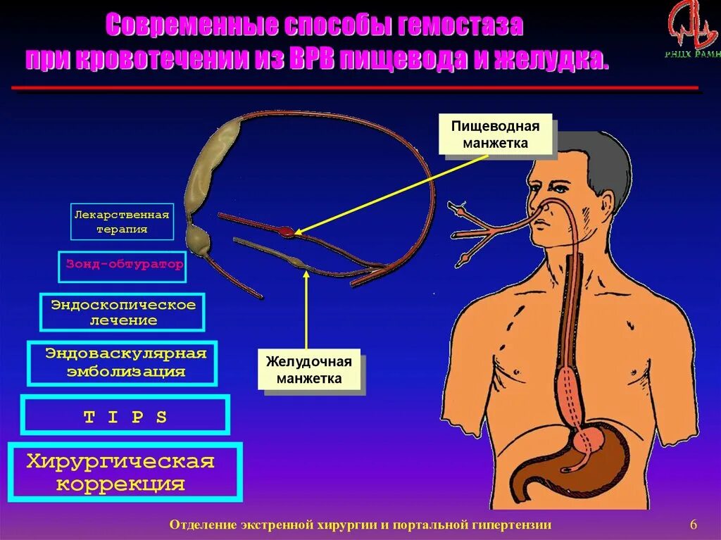 Современные методы гемостаза. Методы гемостаза в хирургии. Эндоваскулярный гемостаз при кровотечениях ЖКТ. Кровотечение из варикозно расширенных вен пищевода.