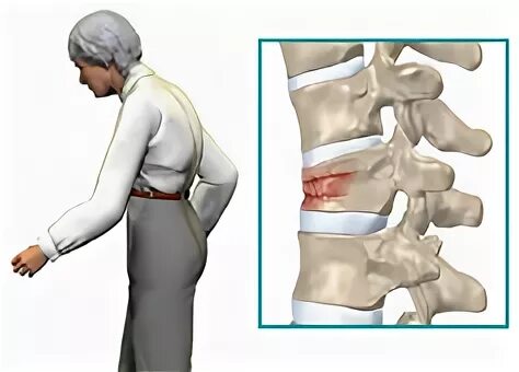 Компрессионный перелом позвоночника алмаг. Компрессионный перелом позвонка грудного отдела. Компрессионный перелом позвоночника вытяжение. Сенильный перелом позвонков.