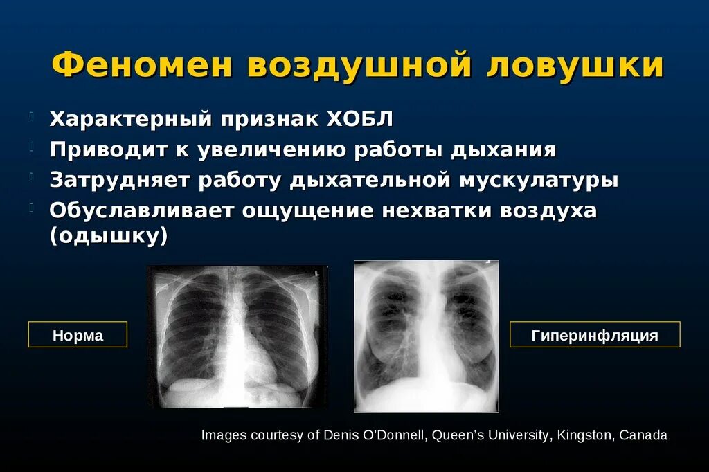 Хроническими болезнями легких астмой. Симптом воздушной ловушки. Воздушные ловушки в легких. Бронхиальная астма на кт. Воздушные ловушки в легких на кт.