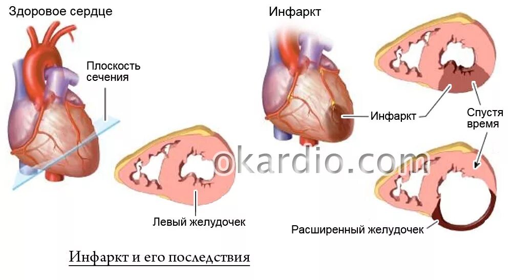 Осложнение на сердце после. Сердце после обширного инфаркта. Обширный инфаркт миокарда последствия.