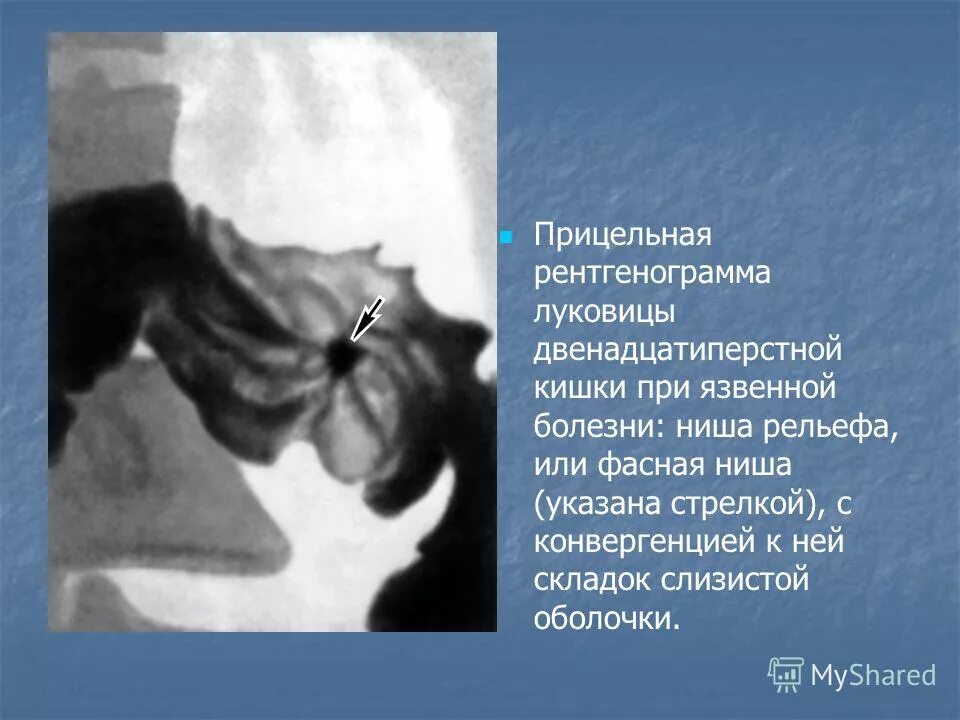 язвенная ниша 12 перстной кишки. симптом луковицы. рентген анатомия желудка в норме. симптом луковицы при периостите. симптом луковицы периостит.