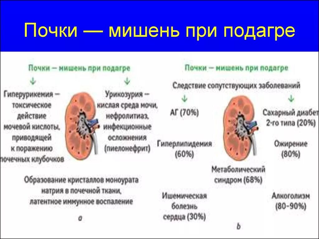 Почка влияет на печень. Подагрическое поражение почек. Поражение почек при подагре. Признаком поражения почек при подагре является.