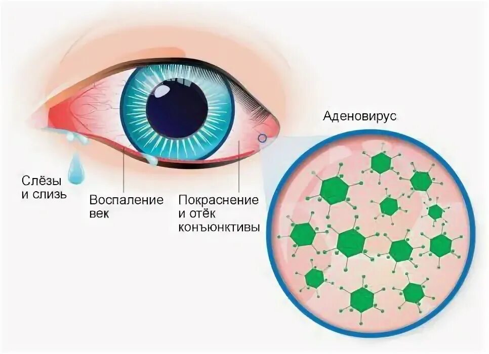 Аденовирусная инфекция конъюнктивит. Аденовирусная инфекция этиология. Патогенез аденовирусной инфекции. Аденовирусная инфекция глаз.