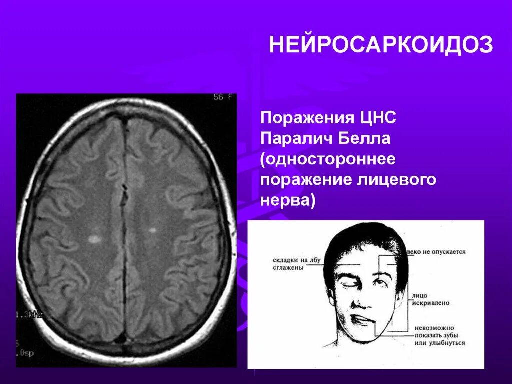 Саркоидоз головного мозга. Саркоидоз нервной системы. Паралич нервной системы. Мрт лицевого нерва