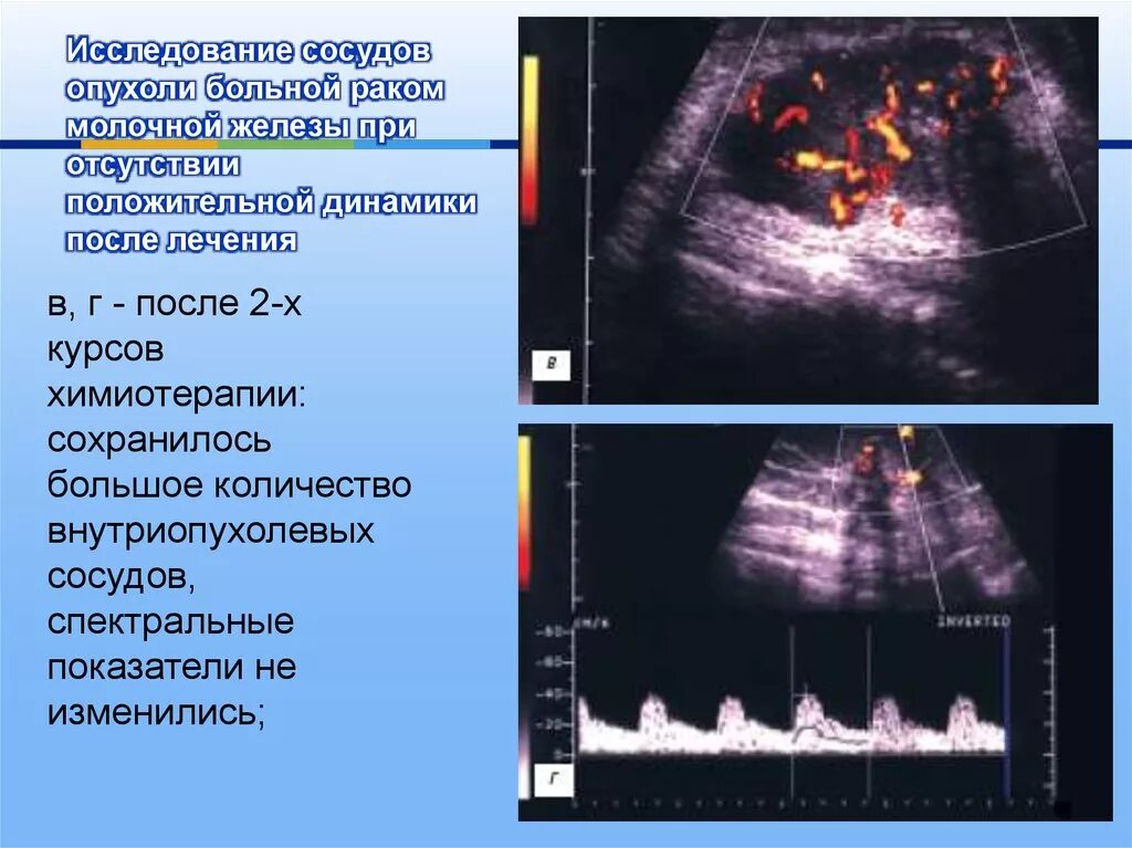 Положительная динамика опухоли. Маммография положительная динамика. Как уменьшить опухоль