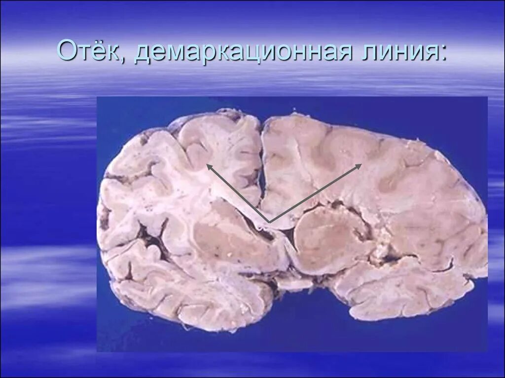 Ишемический инсульт мозг макропрепарат. Отек мозга патанатомия макропрепарат. Отек головного мозга макропрепарат. Отёк головного мозга патологическая анатомия.