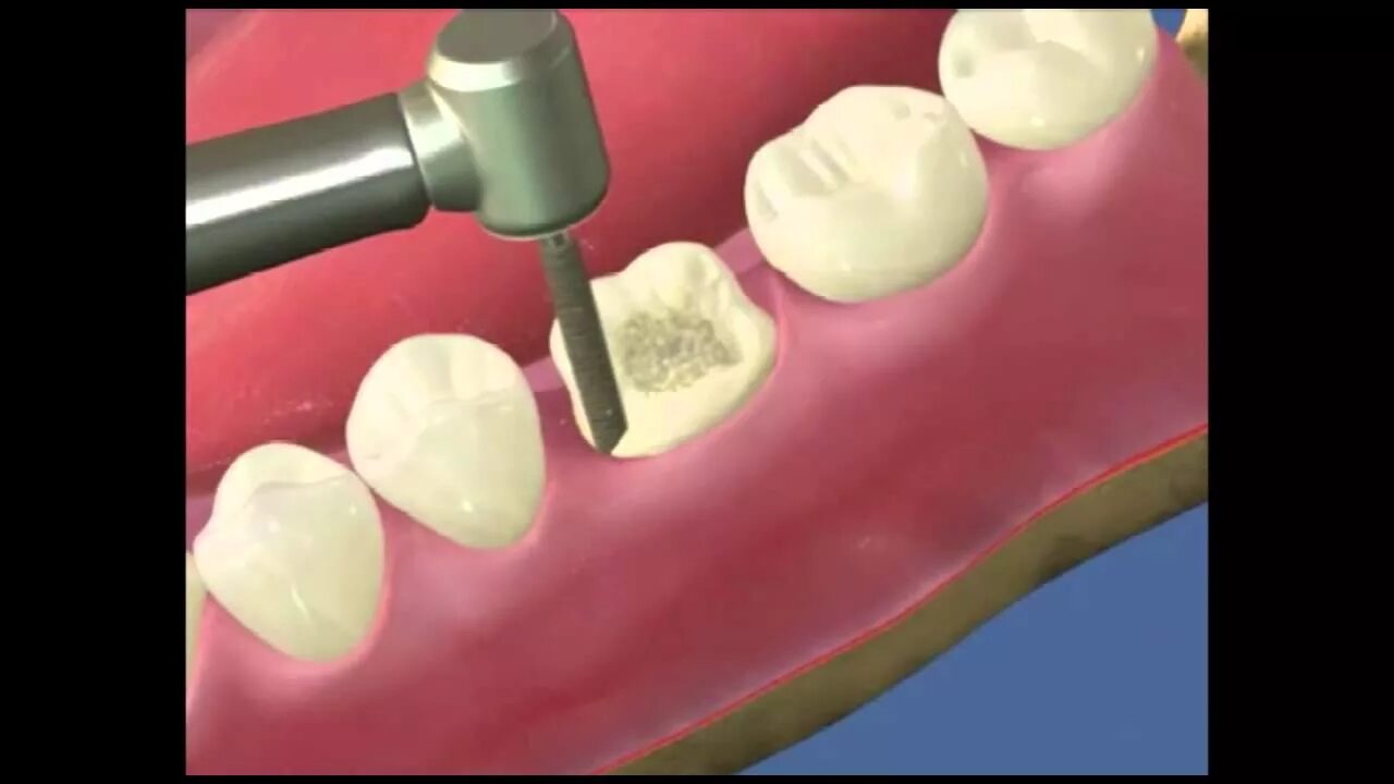 золотые коронки 750 пробы. коронка металлокерамика (золотоплатиновый сплав). безметалловая керамика каркас. безметалловая коронка. штампованная металлическая коронка.