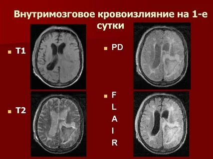 Кровоизлияние в височную долю коры головного мозга