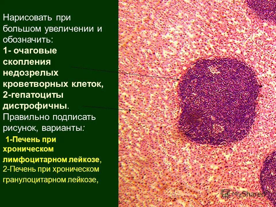 Метастазы при лейкозе. Метастазы при лейкозе. Метастазы при лейкозе. Лейкоз метастазирование. Хронический миелобластный лейкоз мазок крови.