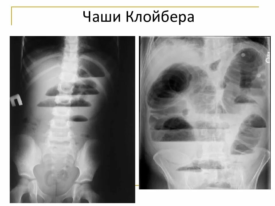 Симптом чаши. Рентген брюшной полости чаши клойбера. кишечная непроходимость рентген чаши клойбера. чаши клойбера при кишечной непроходимости рентген.