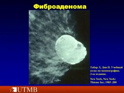 Фиброаденома что это