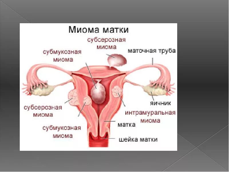 Формы миомы матки. Миома интрамуральный узел. Миомы, субмукозно- интрамуральные. Интрамуральная субмукозная миома матки что это такое.