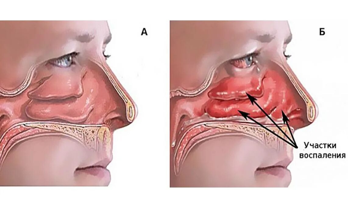 Почему постоянно воспаляется. Вазомоторный ринит,гайморит. Хронический вазомоторный ринит. Вазомоторный ринит полипы. Вазомоторный аллергический ринит.