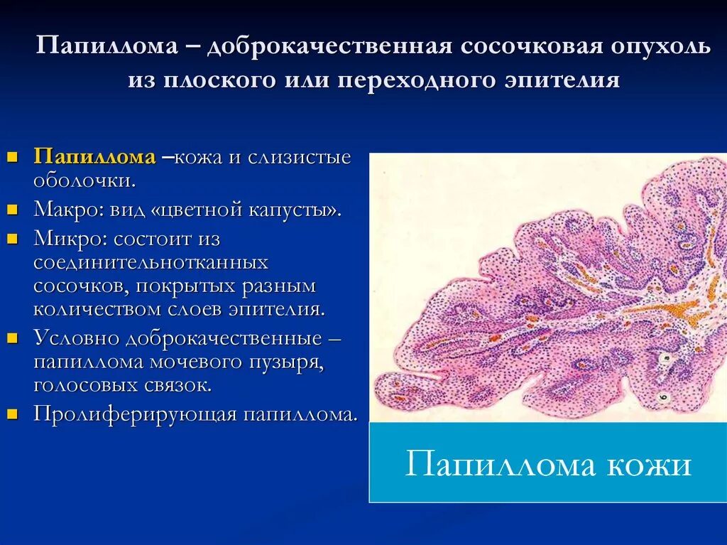 Наиболее часто встречающаяся опухоль. Папиллома патанатомия микропрепарат. Эпителиальные опухоли патоморфология. Доброкачественные эпителиальные опухоли патанатомия. Плоскоклеточная папиллома гистология.