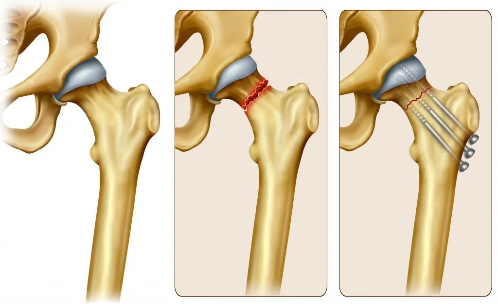 Вколоченный перелом шейки бедра. Перелом шейки бедра гипс. Вколоченный перелом шейки бедренной кости. Вколоченный перелом шейки бедра у пожилых. Симптомы шейка бедра у женщины