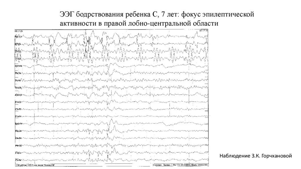 Активность ээг у ребенка что это. ЭЭГ бодрствования. Активное бодрствование ЭЭГ. Электроэнцефалография бодрствования. ЭЭГ бодрствования у детей что это.