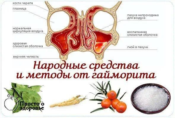 Как лечить синусит у взрослых без температуры