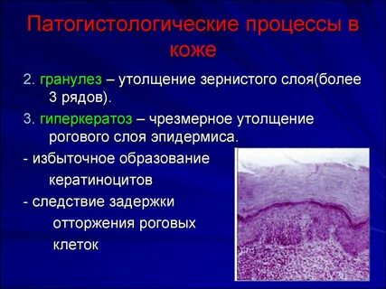 Гиперкератоз плоского эпителия