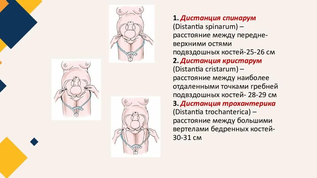 Наружная пельвиометрия в акушерстве. Измерение таза дистанция спинарум. Наружная пельвиометрия алгоритм. Наружная пельвиометрия в акушерстве алгоритм. Измерение женского таза.