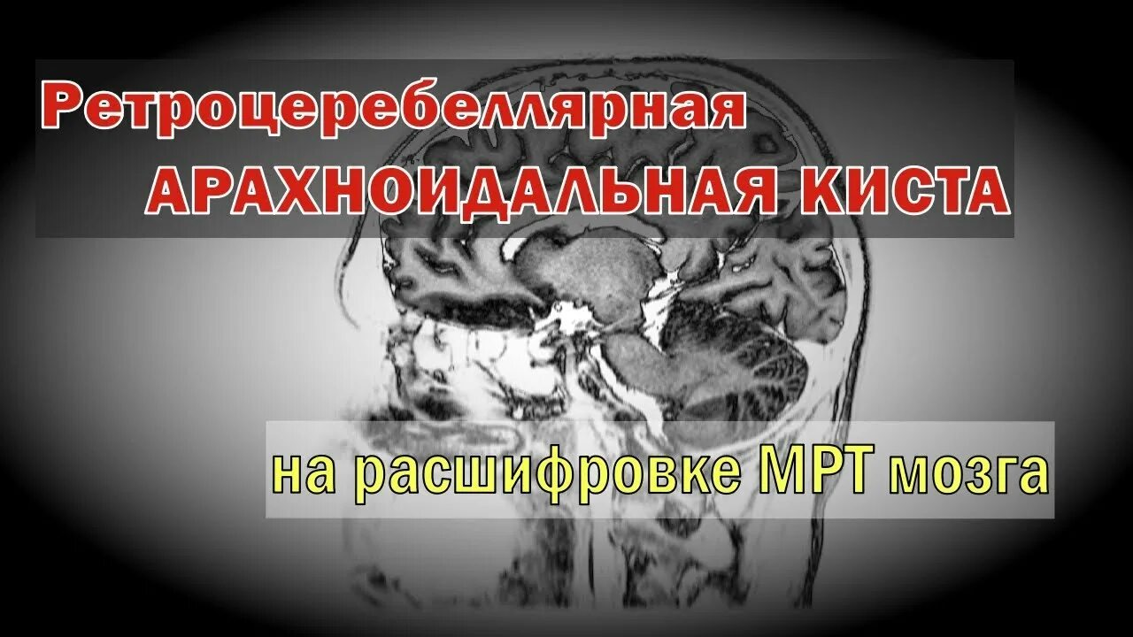 Киста мозга мкб. Ретроцеребральная арахноидальная киста. Ретроцеребеллярной арахноидальной кисты. Ретроцеребеллярная арахноидальная киста в головном. Ретроцеребеллярная арахноидальная киста мрт.