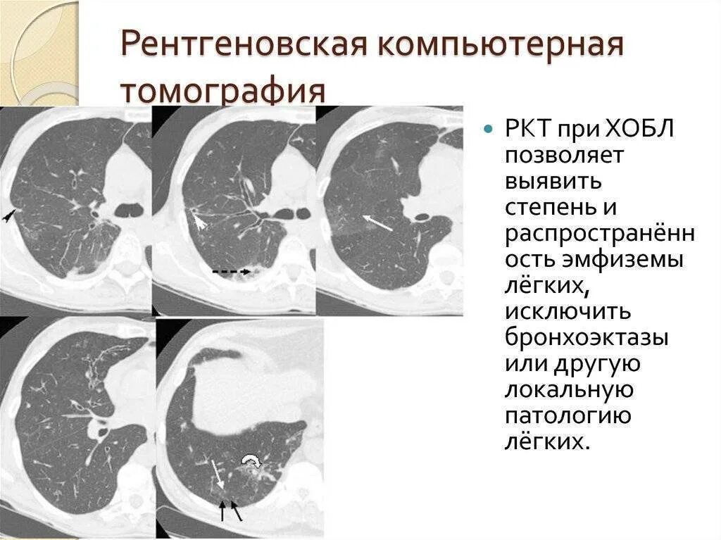 Дерева в почках в легких кт. Хронический обструктивный бронхит на кт. Обструктивный бронхиолит на кт. Хронический бронхиолит на кт. Кт признаки бронхиальной астмы.