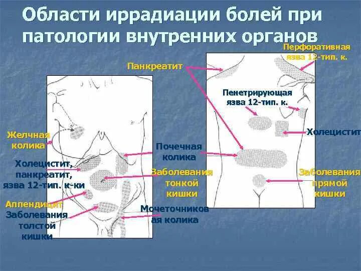 Локализация боли при остром аппендиците. Иррадиация боли при остром панкреатите. Локализация и иррадиация боли при остром панкреатите. Патогенез иррадиирующей боли.