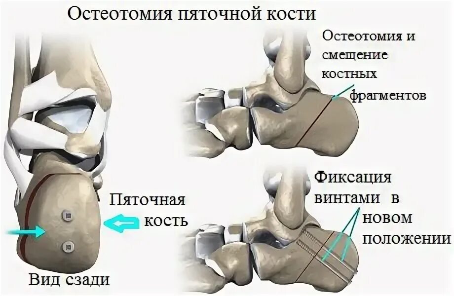 Операция пяточной кости. Корригирующая остеотомия пяточной кости. Остеотомия пяточной кости при плоскостопии. Клиновидная остеотомия пяточной кости. Пяточная кость деформация Хаглунда.