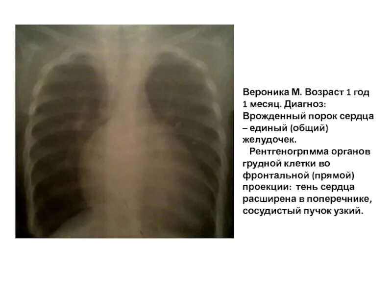 Что значит расширен поперечник сердца. Расширение поперечника сердца причины. расширение сердца в поперечнике рентген. тень сердца увеличена в поперечнике. расширение тени сердца в поперечнике.