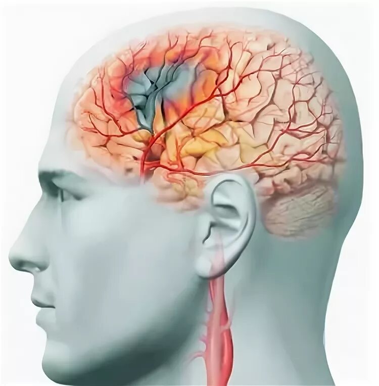 Головная боль сосуды головы. Головные боли и патология сосудов. Сосуды шеи и головы симптомы. Спазм сосудов шеи и головы. Мальформация сосудов головы и шеи лица.