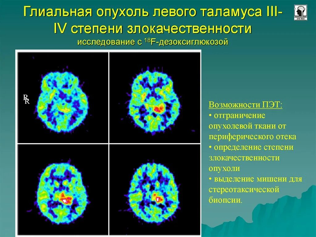 Гипоталамическая гамартома. Опухоль таламуса. Гипоталамическая гамартома. Опухоли зрительного бугра. Позитронно эмиссионная томография презентация.