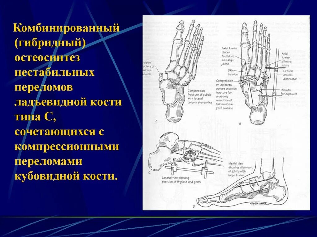 Перелом кости стопы сколько заживает у взрослых. Остеосинтез плюсневой кости стопы. Перелом плюсневой кости стопы рентген. Кубовидная кость стопы перелом на рентгене. Кубовидная кость стопы отломки.