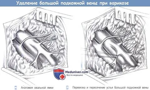 Удаление большой подкожной