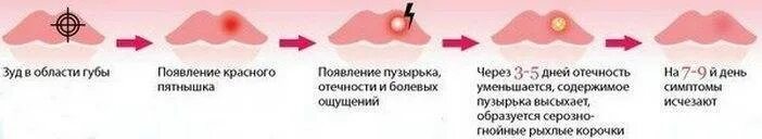 Почему появляется герпес на губах причины. Этапы заживления герпеса. стадии развития герпеса.