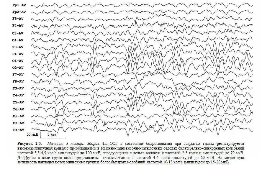 О чем говорит ээг. Электроэнцефалограмма головного мозга здорового ребенка. ЭЭГ нормальные показатели у ребенка. ЭЭГ нормальная расшифровка. Эпилепсия на ЭЭГ.