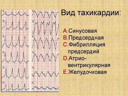 Сколько живут с тахикардией