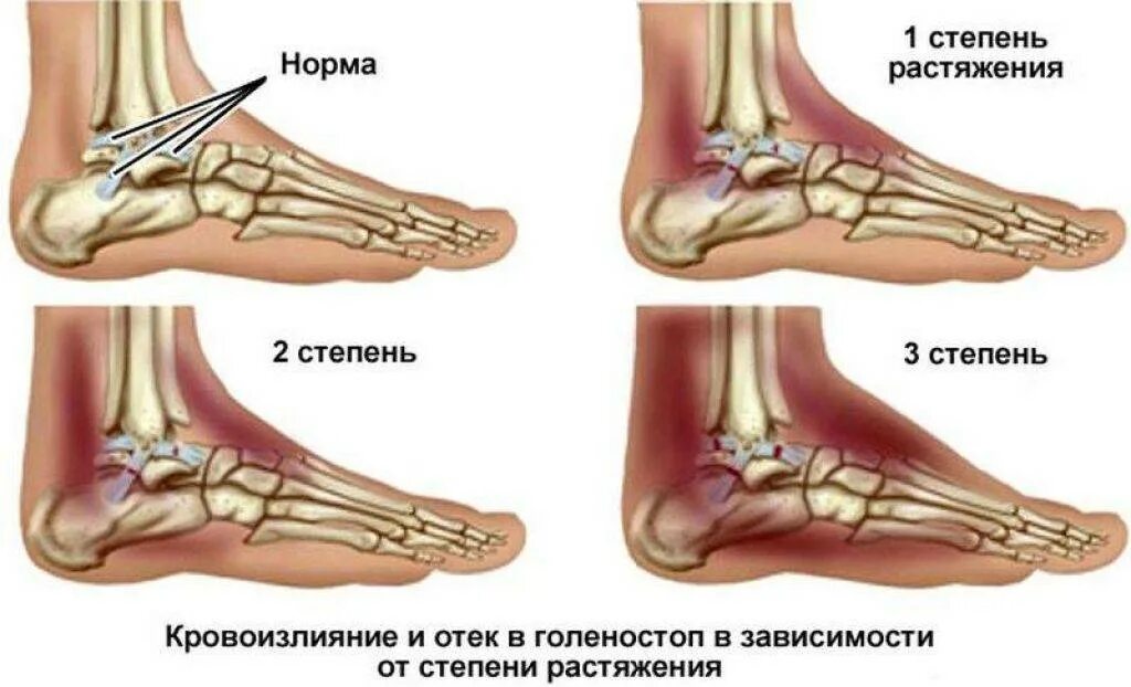 Растяжение связок голеностопного сустава, лечение в домашних условиях