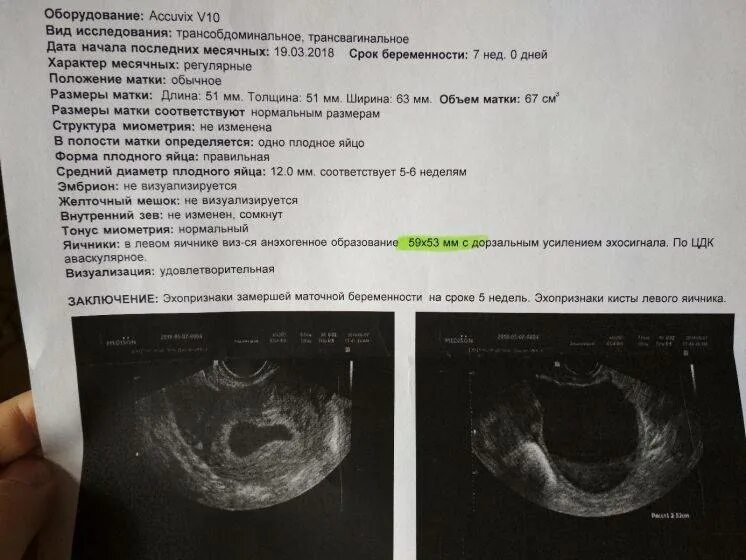 Не видно эмбриона на 7