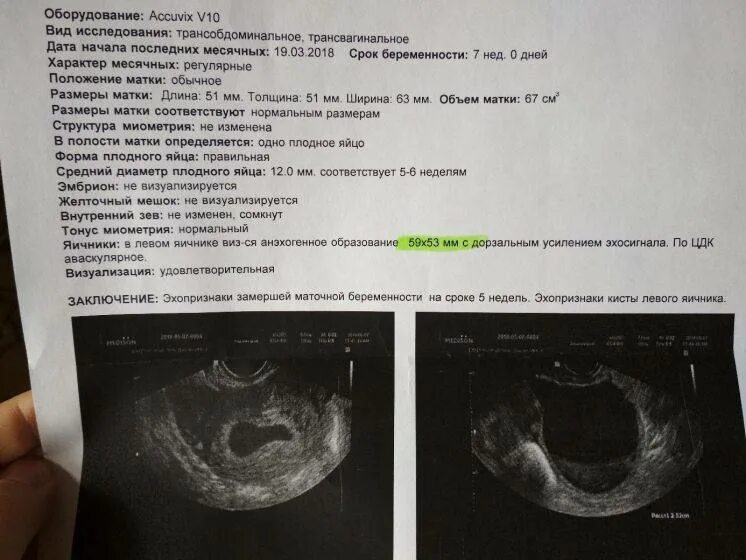 Когда можно увидеть беременность. Нормы УЗИ на 6 неделе беременности. Плодное яйцо 3мм и желточный мешок 3мм. Плодное яйцо 6 недель по УЗИ. Плодное яйцо 10 мм желточный мешок.