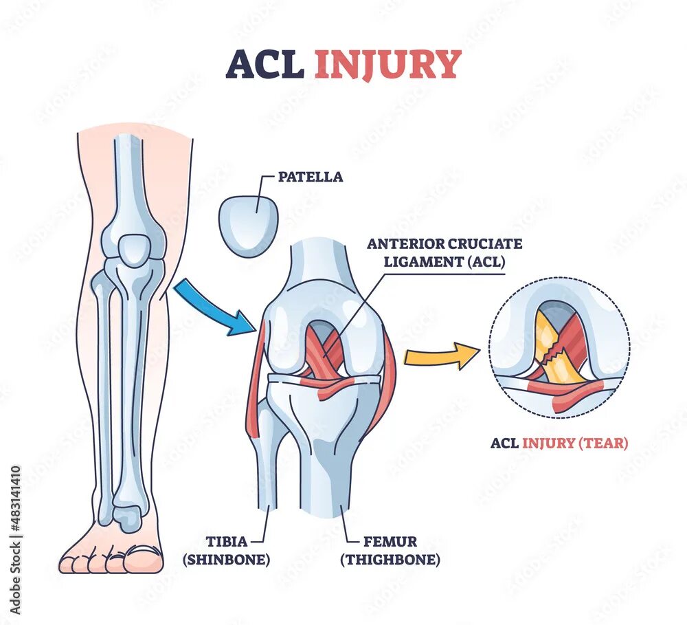 Лигамент. Обызвествление передней крестообразной связки. Крестовидная связка колена. Анатомия коленного сустава мрт. Крестообразная мышца в колене.
