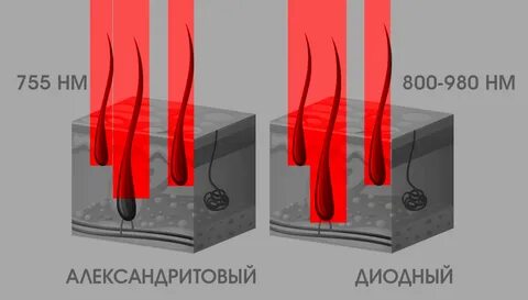 Лазер александрит отзывы