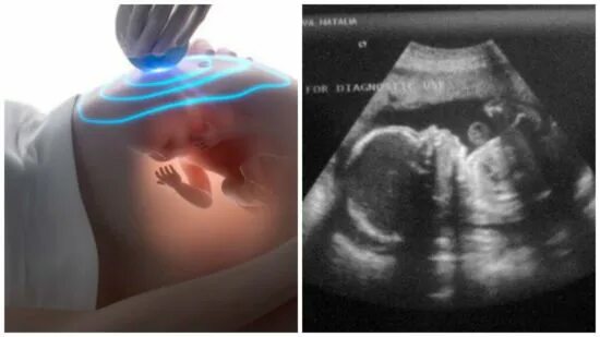 узи ребенка на 35 неделе беременности. узи на 35 неделе беременности пол ребенка. узи плода на 36 неделе беременности. 36 недель беременности мальчик. фото узи 36 недель беременности.