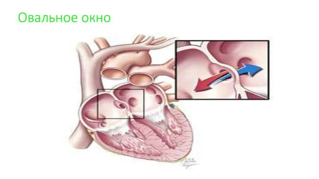 Функционирующее овальное. Открытое овальное окно в сердце у новорожденного 2мм. Овальное окно в сердце у детей 6мм. Незаращение овального окна у детей. Овальное отверстие между предсердиями.