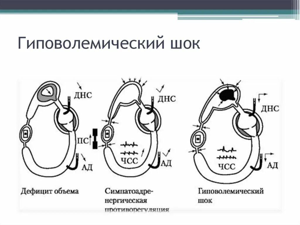 Гиповолемический ШОК. Гиповолемический ШОК картинки. Гиповолемический ШОК У детей. Гиповолемический ШОК презентация. Гиповолемический шок тест