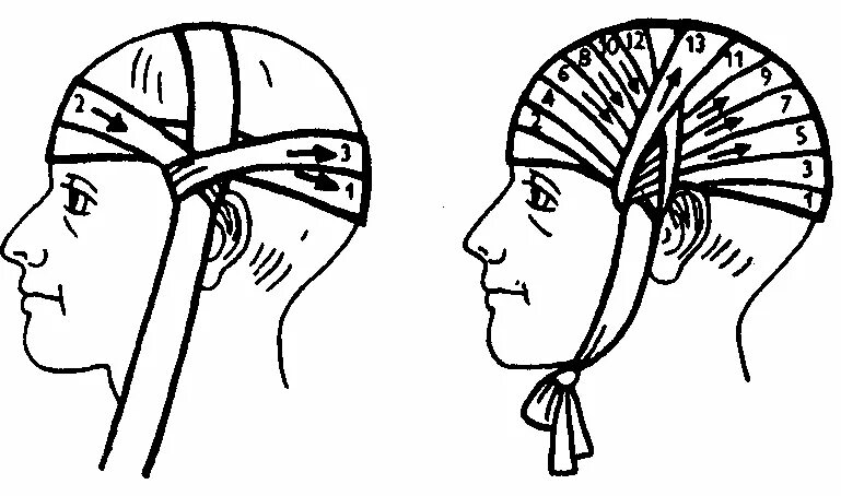 Бинтование чепец. Бинтование головы чепец. Техника наложения повязки чепец. Техника перевязки головы чепец. Как перевязывать голову