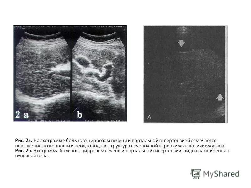 УЗИ признаки цирроза печени. Микронодулярный цирроз печени УЗИ. Цирроз печени эхограмма. Эхогенность паренхимы печени.