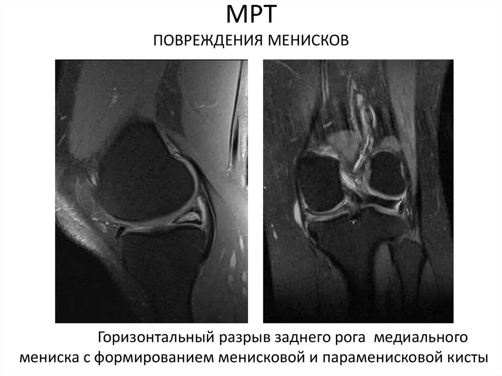 Дистрофические изменения заднего рога. Радиальный разрыв мениска мрт. Анатомия менисков коленного сустава мрт. Повреждение внутреннего мениска мрт. Разрыв заднего рога медиального мениска на мрт.